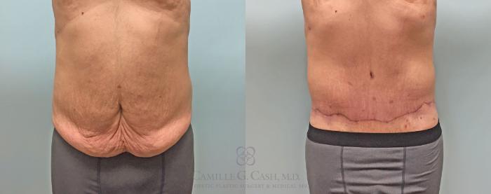 Before & After Body Contouring for Men Case 214 View #1 View in Houston, TX