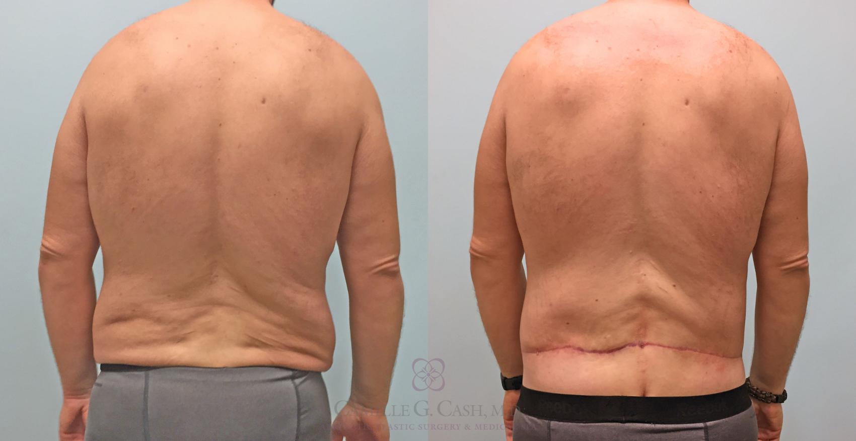 Before & After Body Contouring for Men Case 214 View #2 View in Houston, TX
