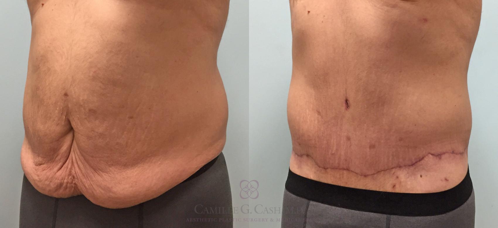 Before & After Body Contouring for Men Case 214 View #3 View in Houston, TX