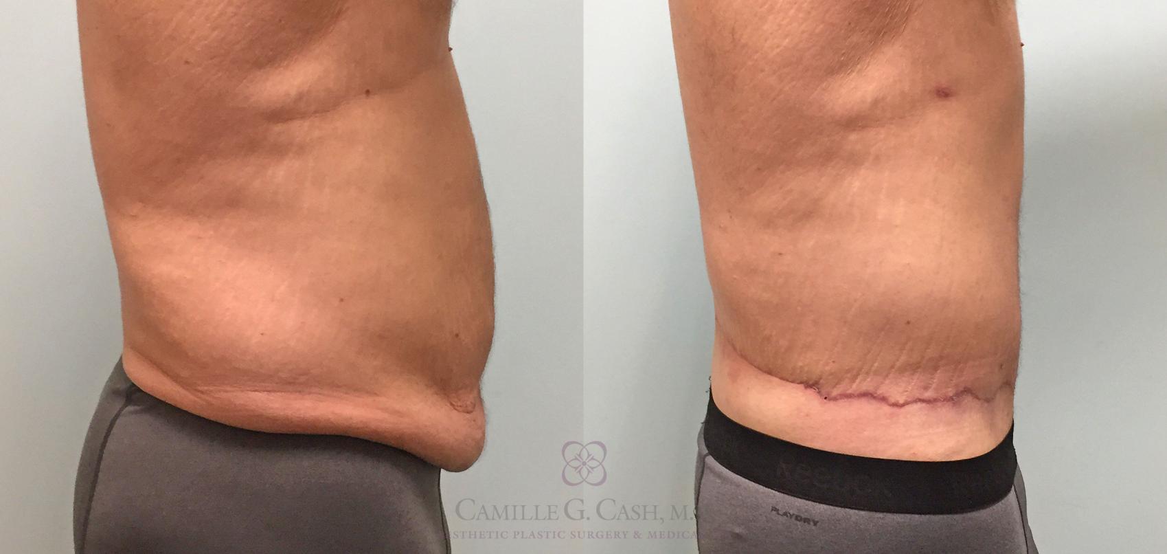 Before & After Body Contouring for Men Case 214 View #4 View in Houston, TX