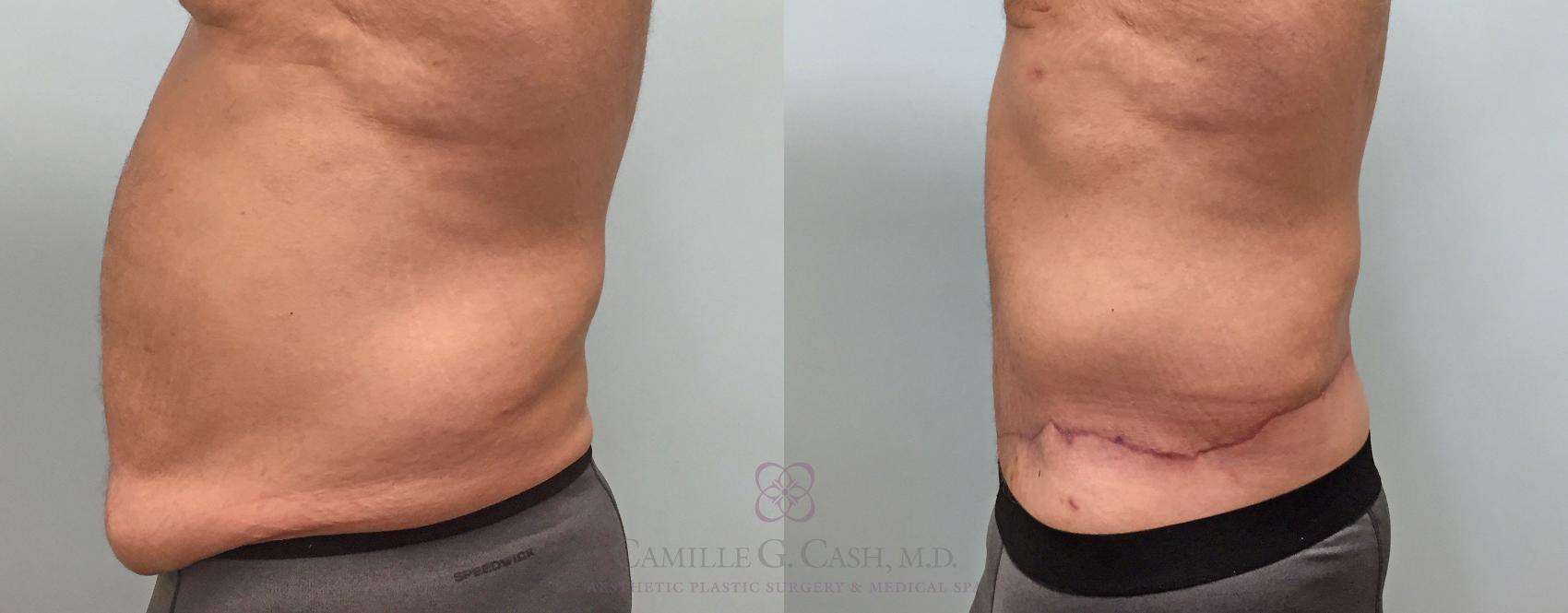 Before & After Body Contouring for Men Case 214 View #5 View in Houston, TX