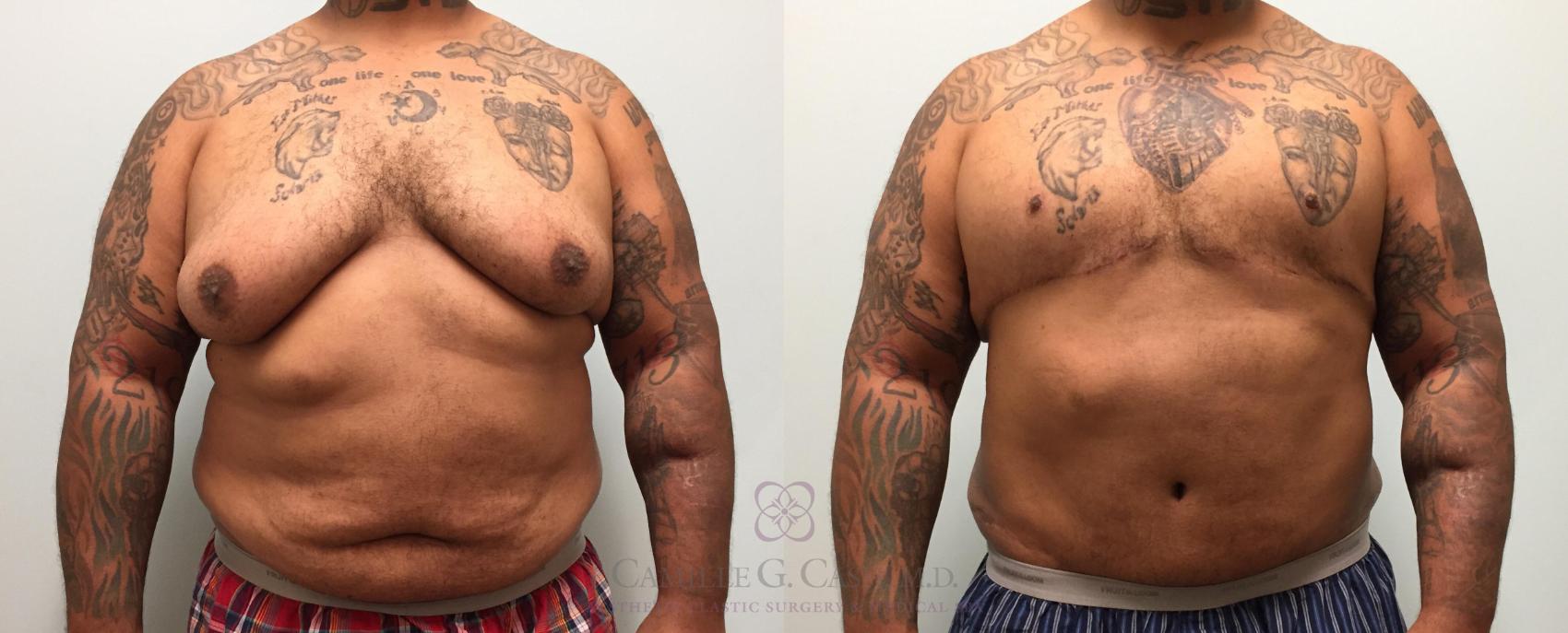 Before & After Body Contouring for Men Case 226 View #1 View in Houston, TX