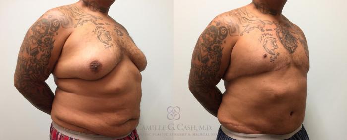 Before & After Body Contouring for Men Case 226 View #2 View in Houston, TX