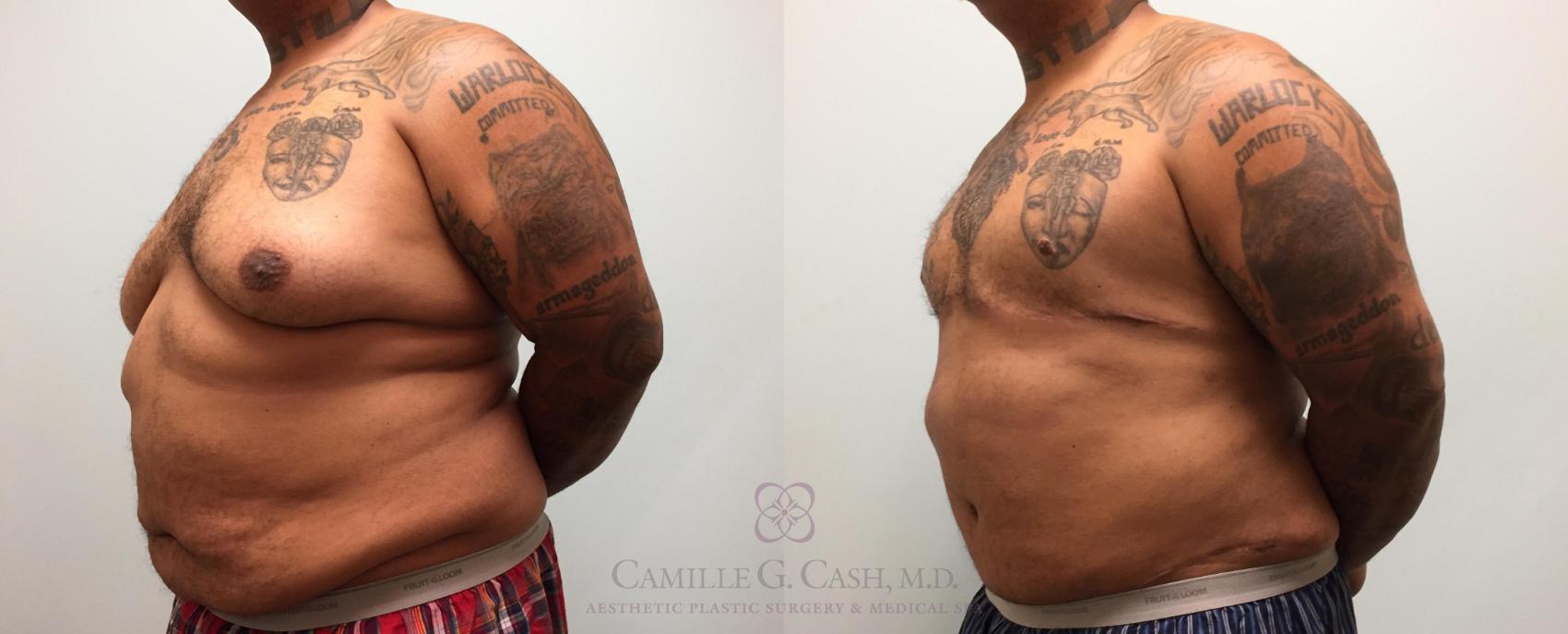 Before & After Body Contouring for Men Case 226 View #3 View in Houston, TX
