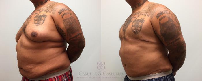 Before & After Body Contouring for Men Case 226 View #3 View in Houston, TX