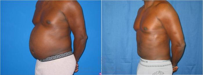 Before & After Body Contouring for Men Case 28 View #1 View in Houston, TX