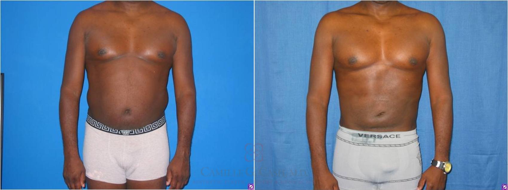 Before & After Body Contouring for Men Case 28 View #2 View in Houston, TX