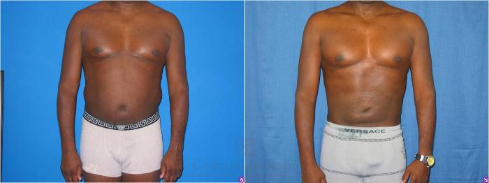 Before & After Body Contouring for Men Case 28 View #2 View in Houston, TX