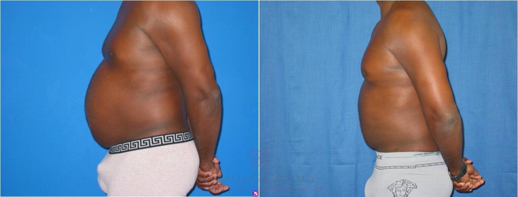 Before & After Body Contouring for Men Case 28 View #4 View in Houston, TX