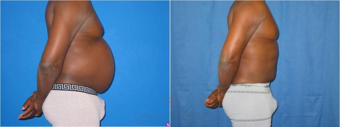 Before & After Body Contouring for Men Case 28 View #5 View in Houston, TX