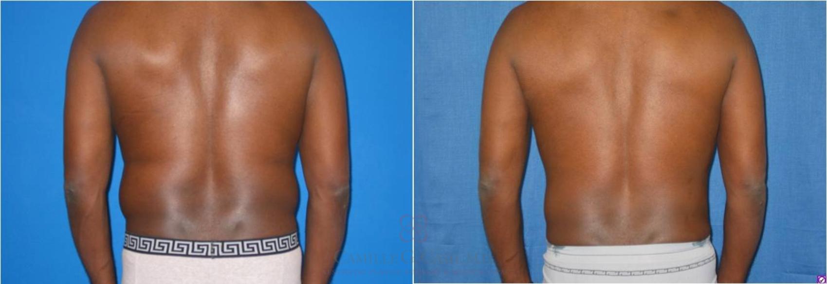 Before & After Body Contouring for Men Case 28 View #6 View in Houston, TX
