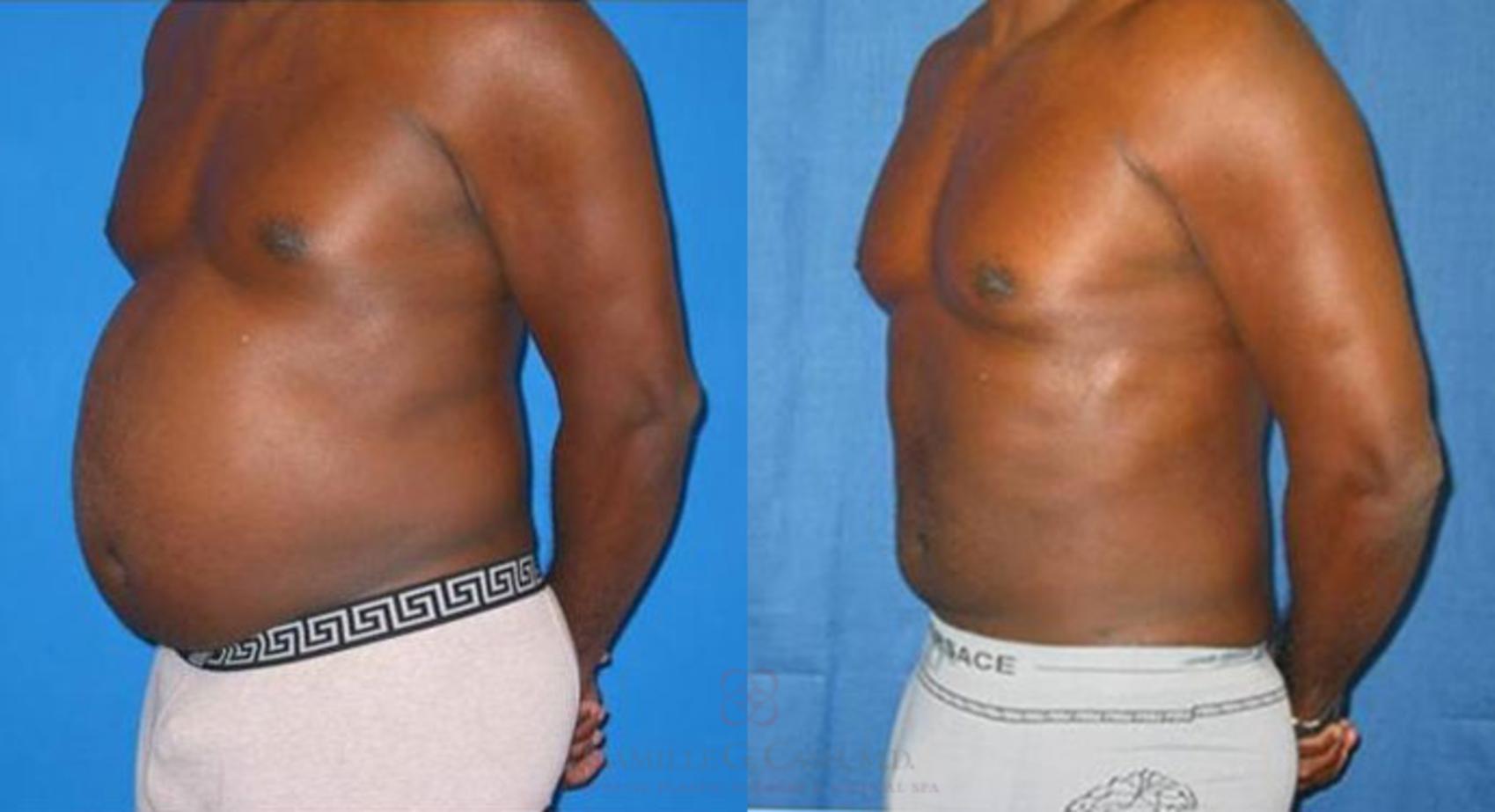 Before & After Body Contouring for Men Case 28 View #7 View in Houston, TX