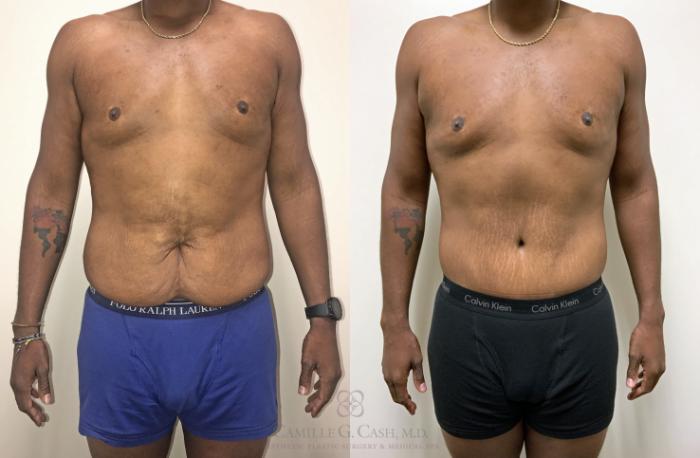 Before & After Post-Weight Loss Body Contouring Case 318 View #1 View in Houston, TX