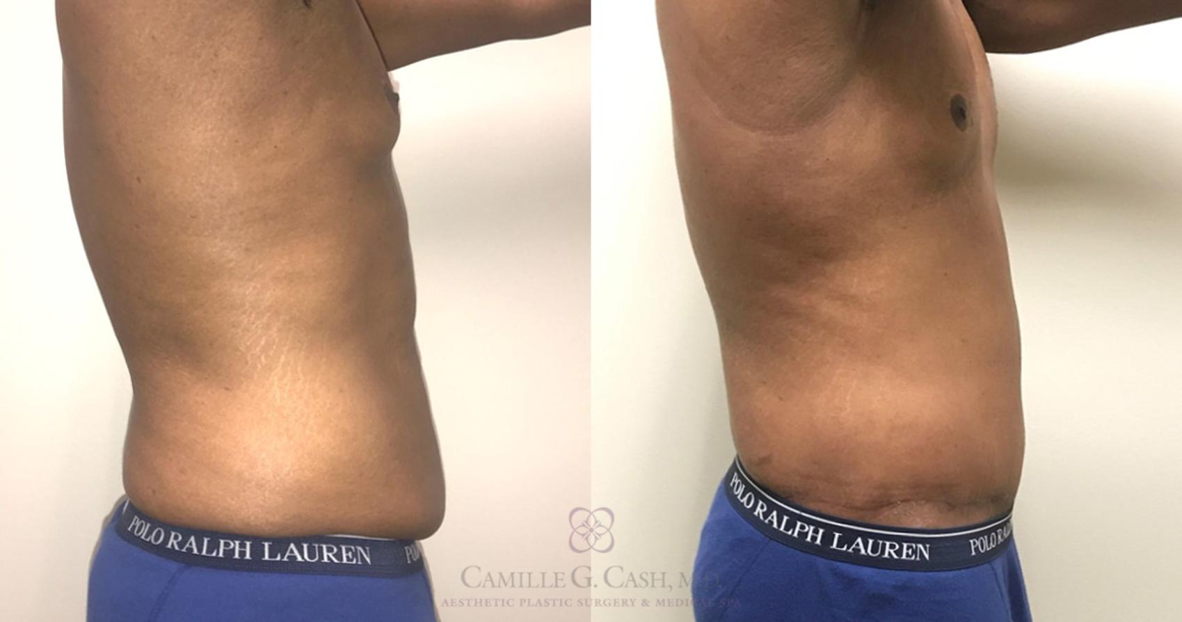 Before & After Post-Weight Loss Body Contouring Case 318 View #10 View in Houston, TX