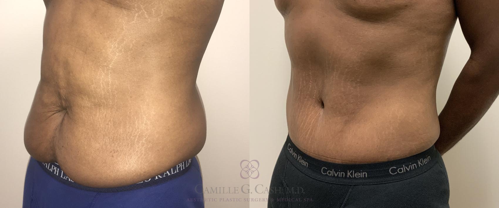 Before & After Post-Weight Loss Body Contouring Case 318 View #2 View in Houston, TX