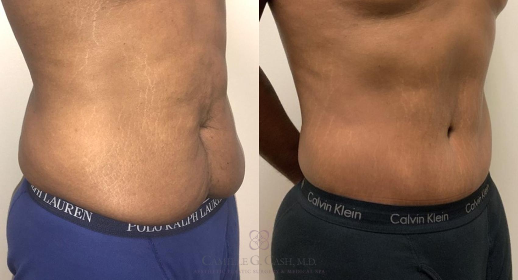 Before & After Tummy Tuck Case 318 View #3 View in Houston, TX