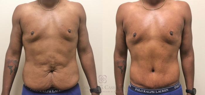Before & After Body Contouring for Men Case 318 View #4 View in Houston, TX