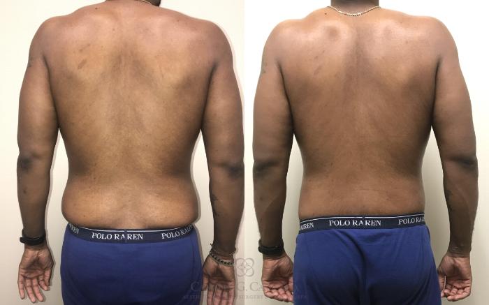 Before & After Body Contouring for Men Case 318 View #5 View in Houston, TX
