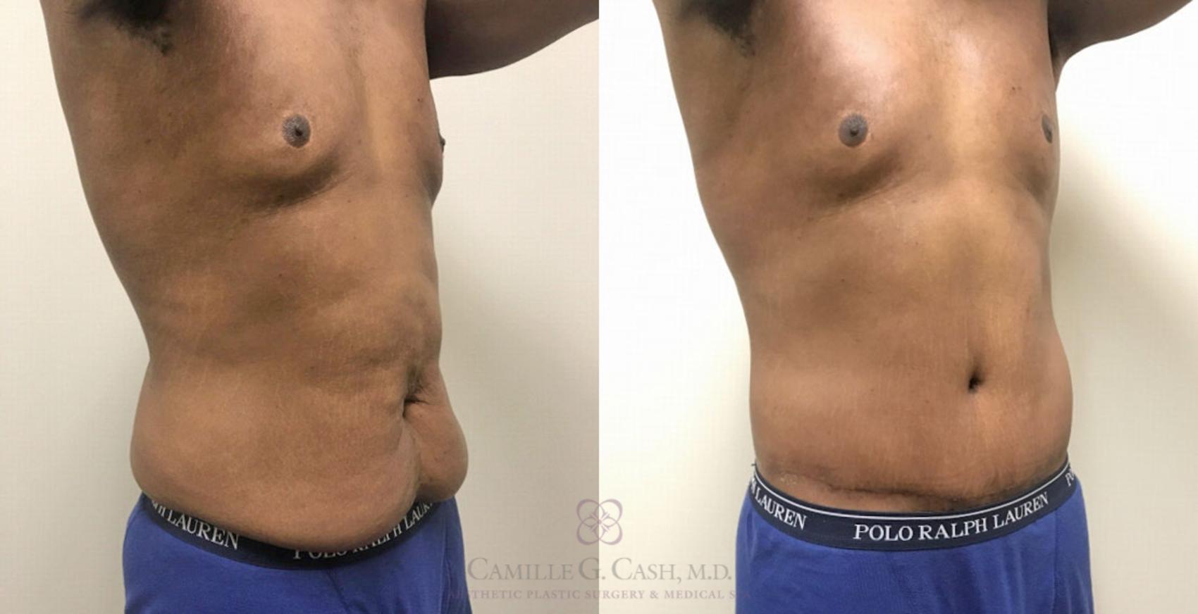 Before & After Post-Weight Loss Body Contouring Case 318 View #6 View in Houston, TX