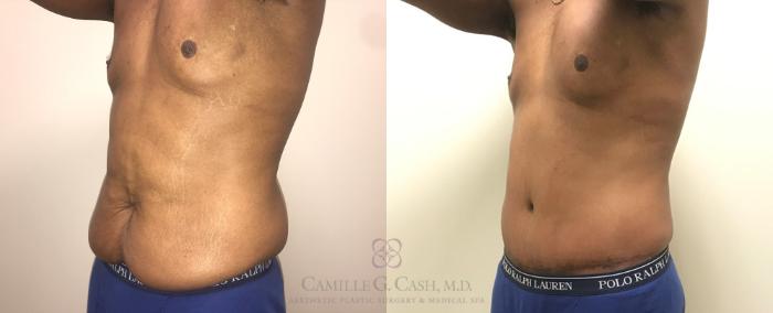 Before & After Body Contouring for Men Case 318 View #7 View in Houston, TX