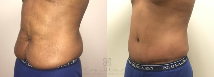 Before & After Tummy Tuck Case 318 View #8 View in Houston, TX