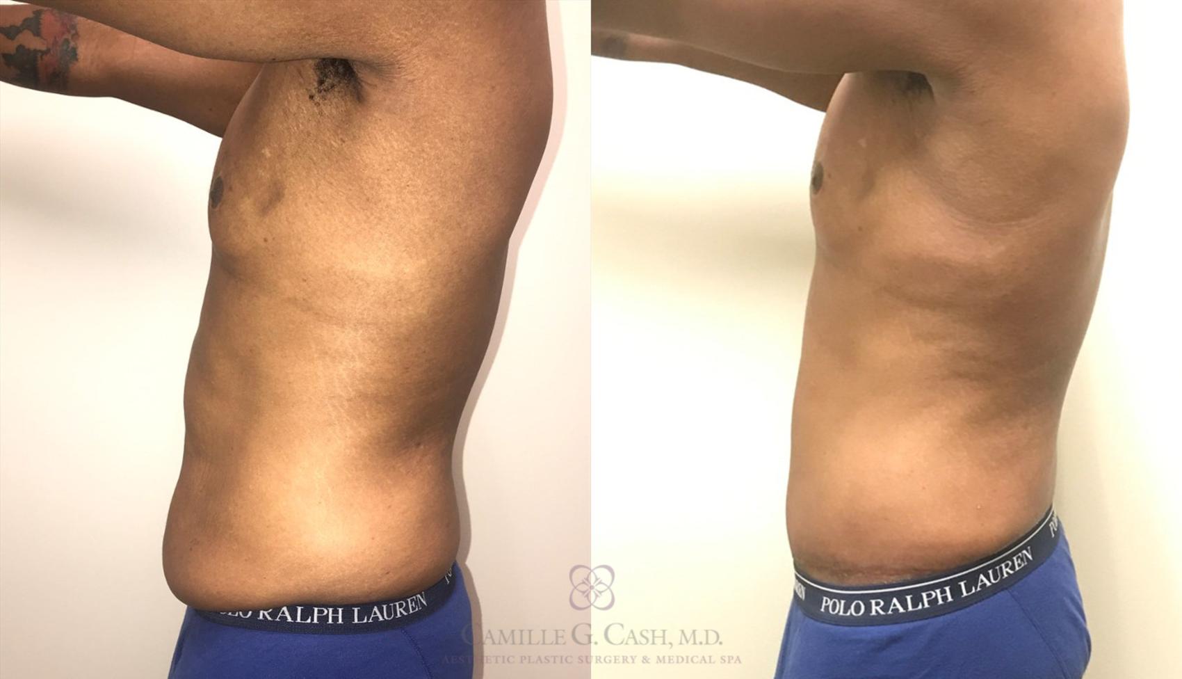 Before & After Tummy Tuck Case 318 View #9 View in Houston, TX