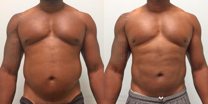 Before & After Body Contouring for Men Case 319 View #1 View in Houston, TX