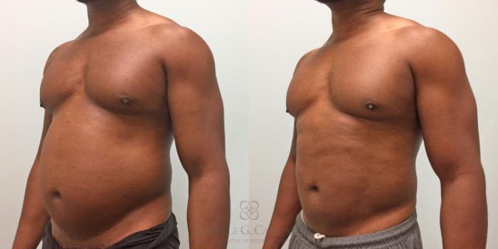 Before & After Body Contouring for Men Case 319 View #2 View in Houston, TX