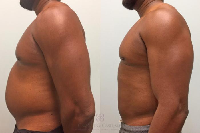 Before & After Body Contouring for Men Case 319 View #3 View in Houston, TX