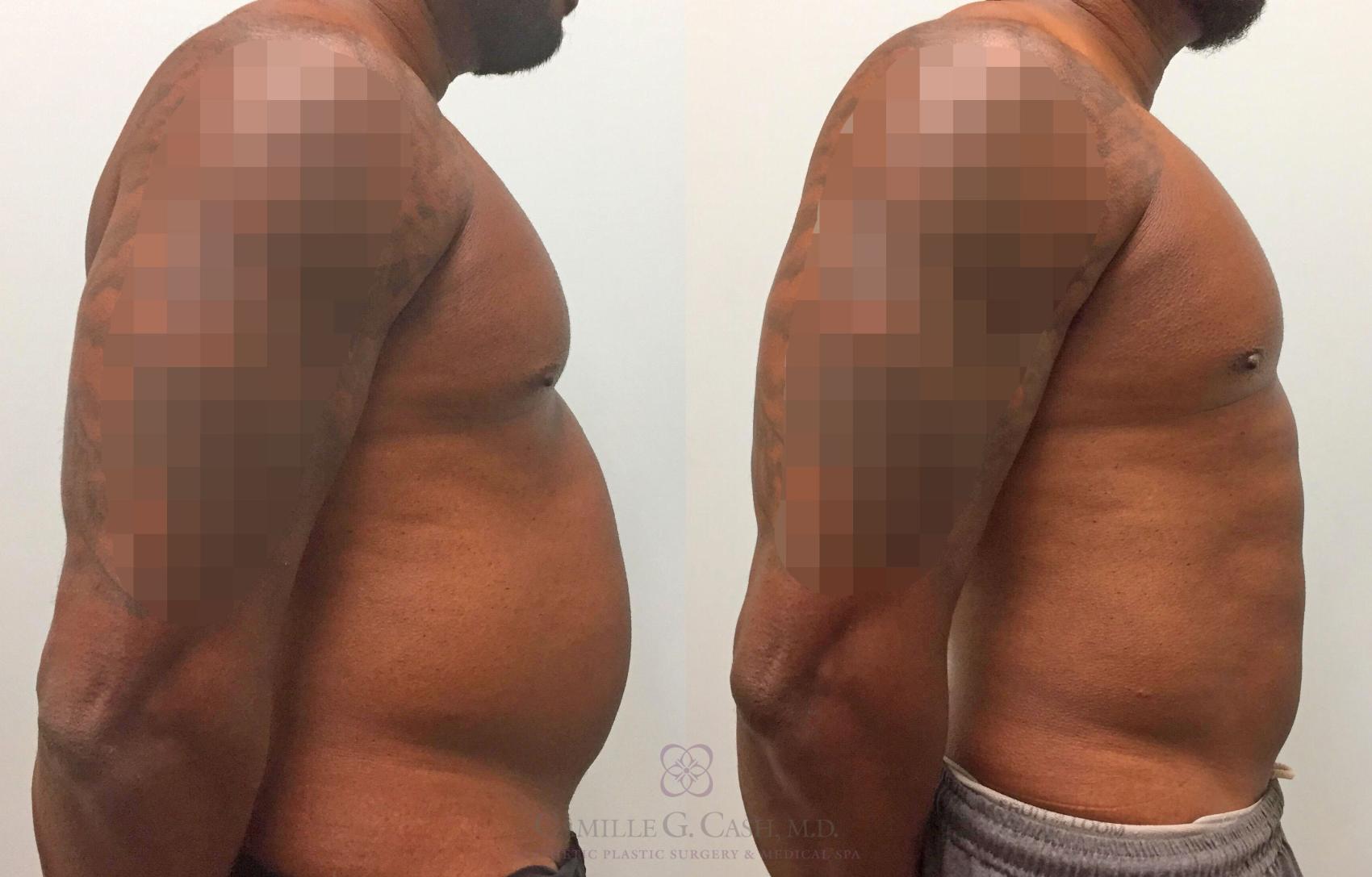 Before & After Body Contouring for Men Case 319 View #4 View in Houston, TX