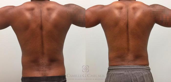 Before & After Body Contouring for Men Case 319 View #5 View in Houston, TX
