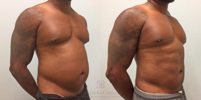 Before & After Body Contouring for Men Case 319 View #6 View in Houston, TX