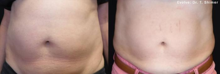 Before & After Body Contouring for Men Case 495 Front View in Houston, TX