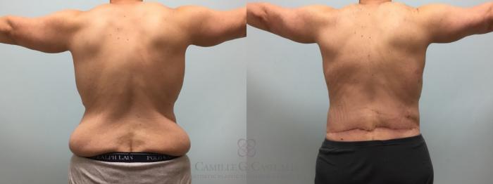 Before & After Body Contouring for Men Case 514 Back View in Houston, TX