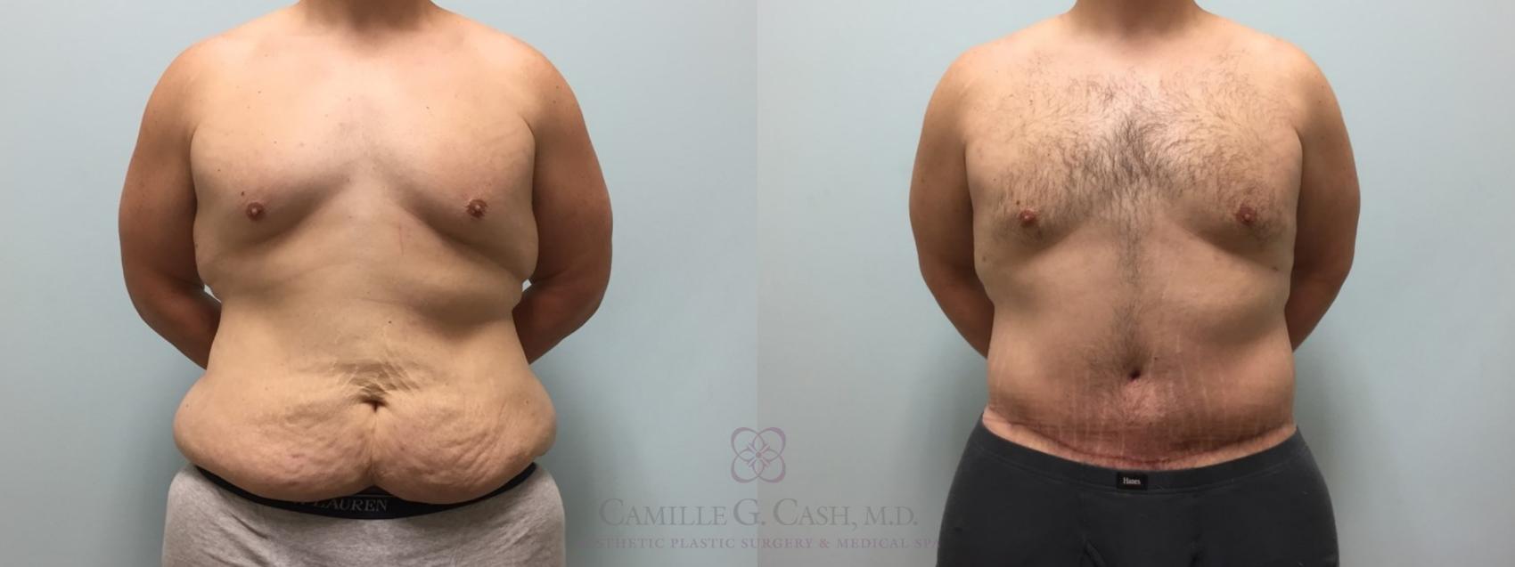 Before & After Body Contouring for Men Case 514 front 2 View in Houston, TX