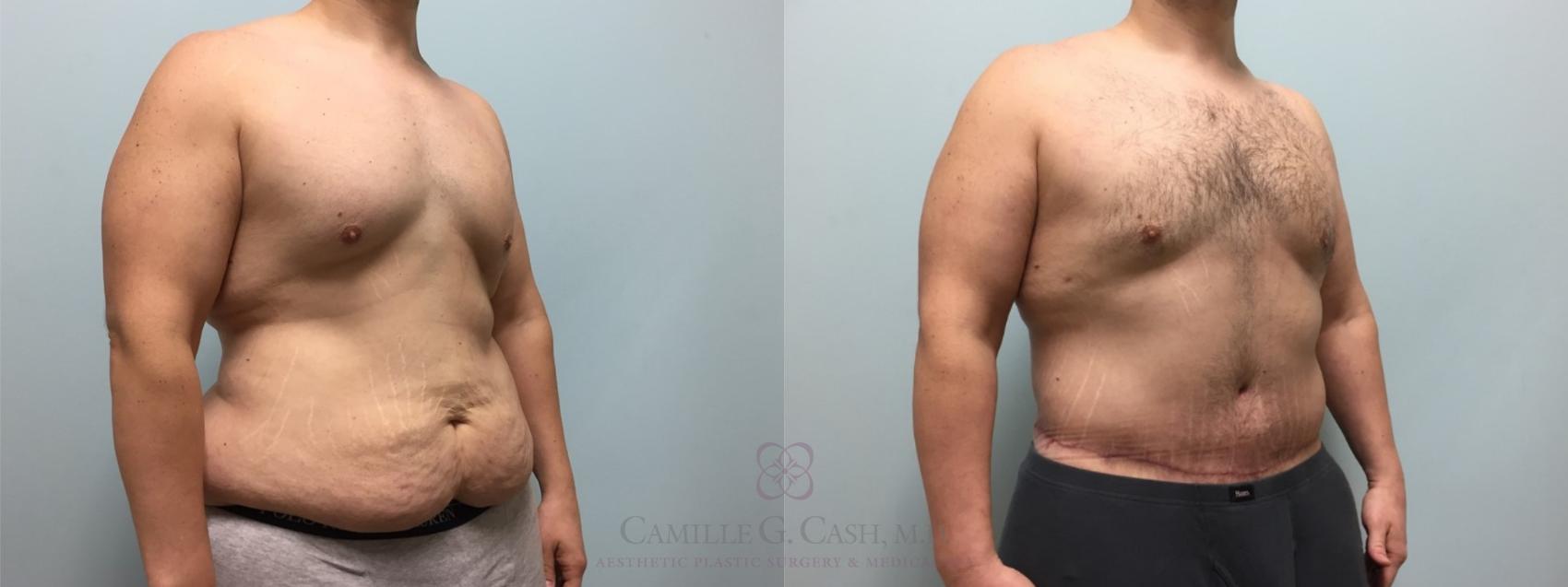 Before & After Body Contouring for Men Case 514 Left Oblique View in Houston, TX