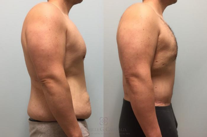 Before & After Body Contouring for Men Case 514 Left Side View in Houston, TX