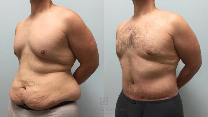 Body Contouring for Men Before and After Pictures Case 514