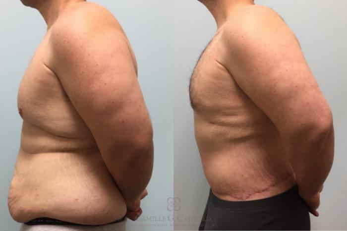 Before & After Body Contouring for Men Case 514 Right Side View in Houston, TX