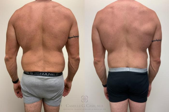 Before & After Body Contouring for Men Case 623 Back View in Houston, TX
