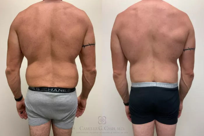 Body Contouring for Men Before and After Pictures Case 514, Houston, TX