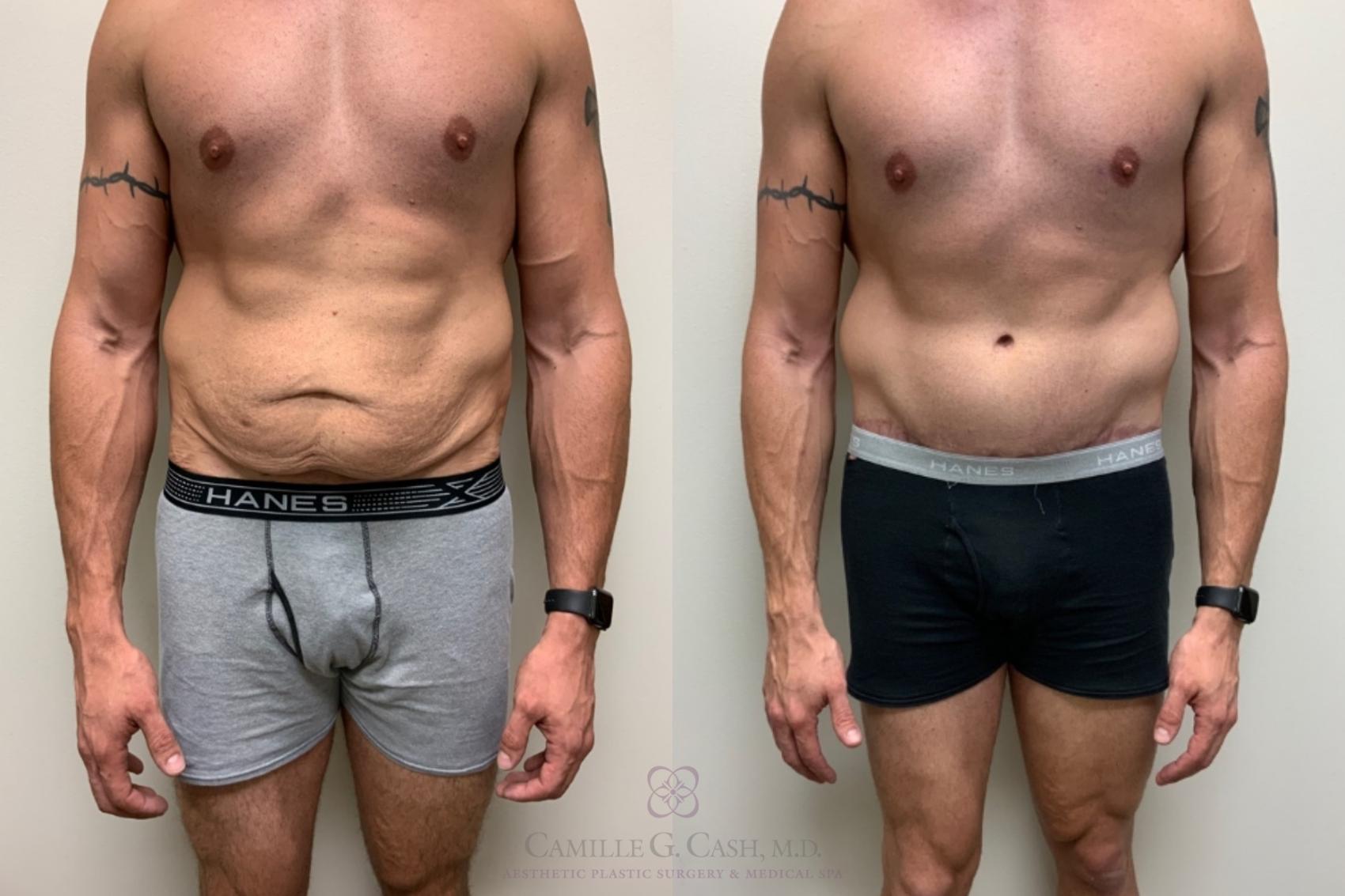 Before & After Body Contouring for Men Case 623 Front View in Houston, TX