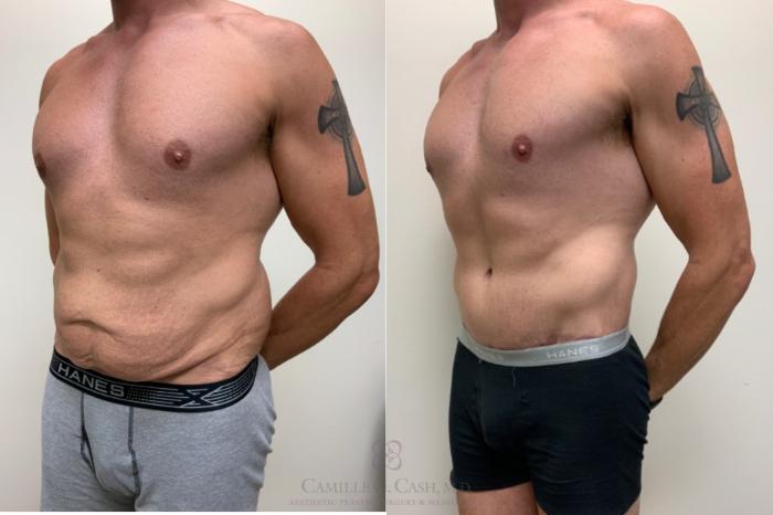 Before & After Body Contouring for Men Case 623 Left Oblique View in Houston, TX