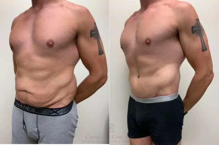 Body Contouring for Men Before and After Pictures Case 623