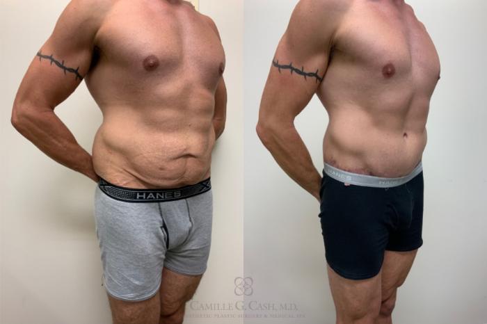 Before & After Body Contouring for Men Case 623 Right Oblique View in Houston, TX