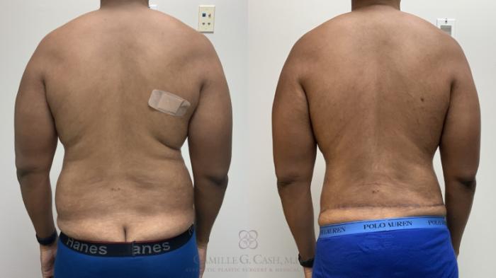 Before & After Tummy Tuck Case 695 Back View in Houston, TX