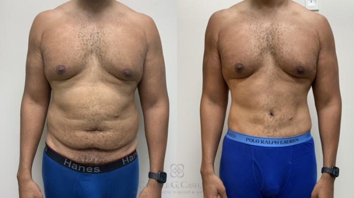 Before & After Body Contouring for Men Case 695 Front View in Houston, TX