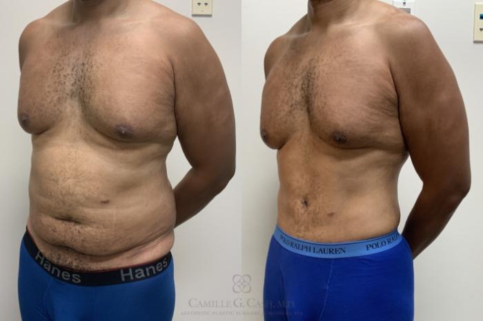 Before & After Post-Weight Loss Body Contouring Case 695 Left Oblique View in Houston, TX