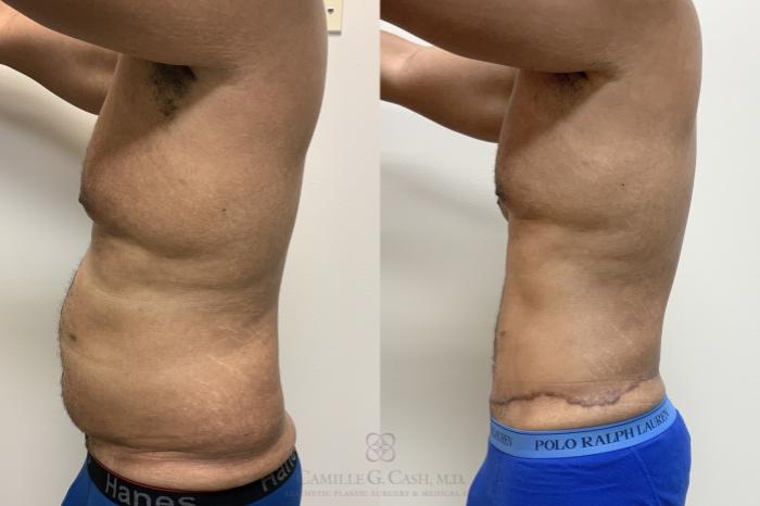 Before & After Tummy Tuck Case 695 Left Side View in Houston, TX