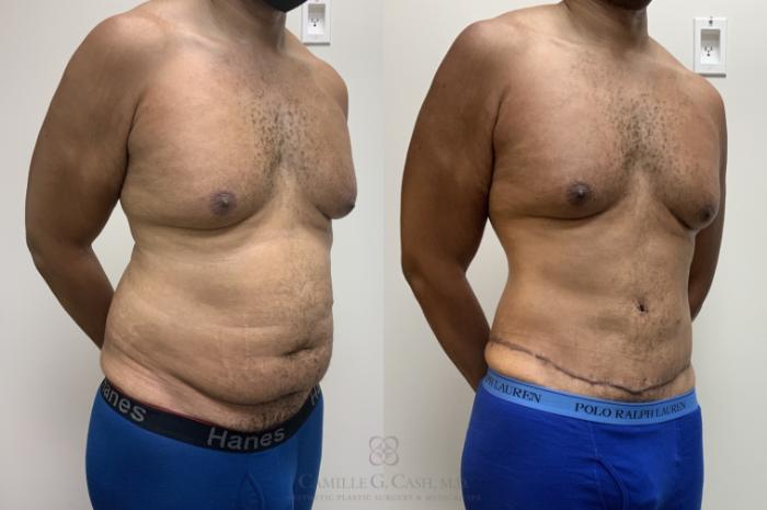 Before & After Tummy Tuck Case 695 oblique 2 View in Houston, TX